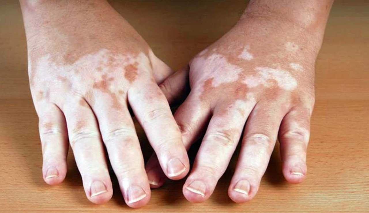 La enfermedad de las manchas en la piel: ¿qué es y qué síntomas presenta el vitiligo?