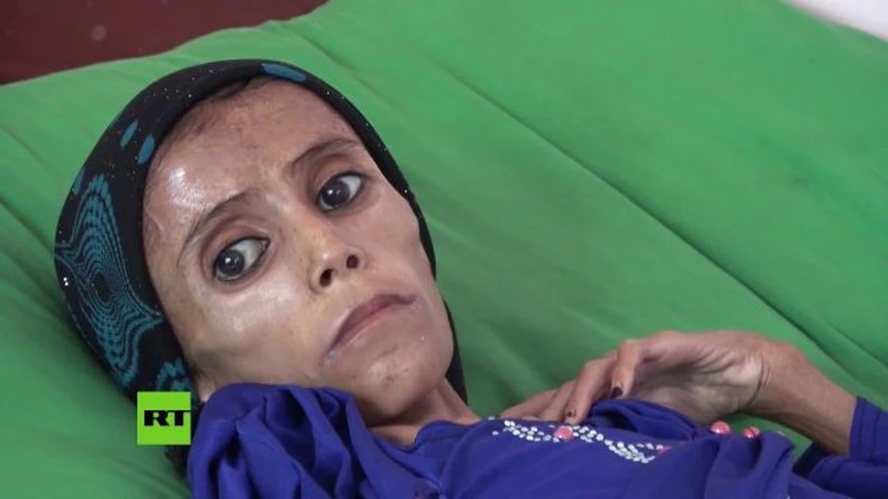 El triste video de la nena desnutrida que pesa 10 kilos recorre el mundo