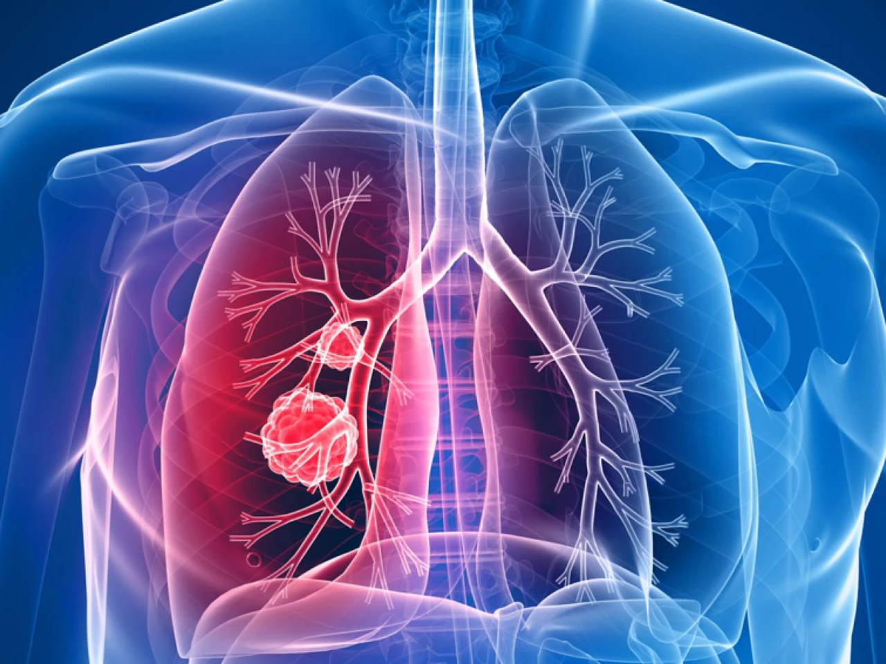 Tabaré Vázquez anunció que tiene un nódulo pulmonar: qué es y cómo se trata