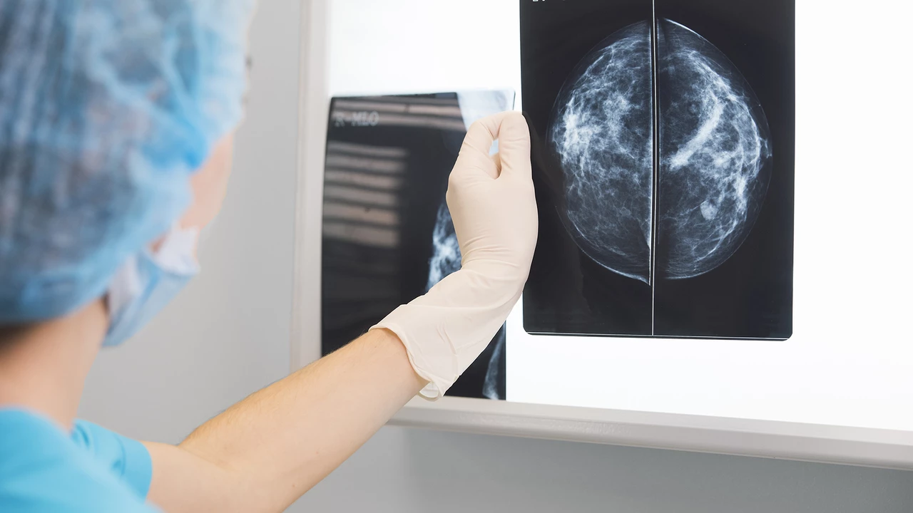 1 de cada 8 mujeres puede desarrollar cáncer de mama: la importancia del chequeo anual