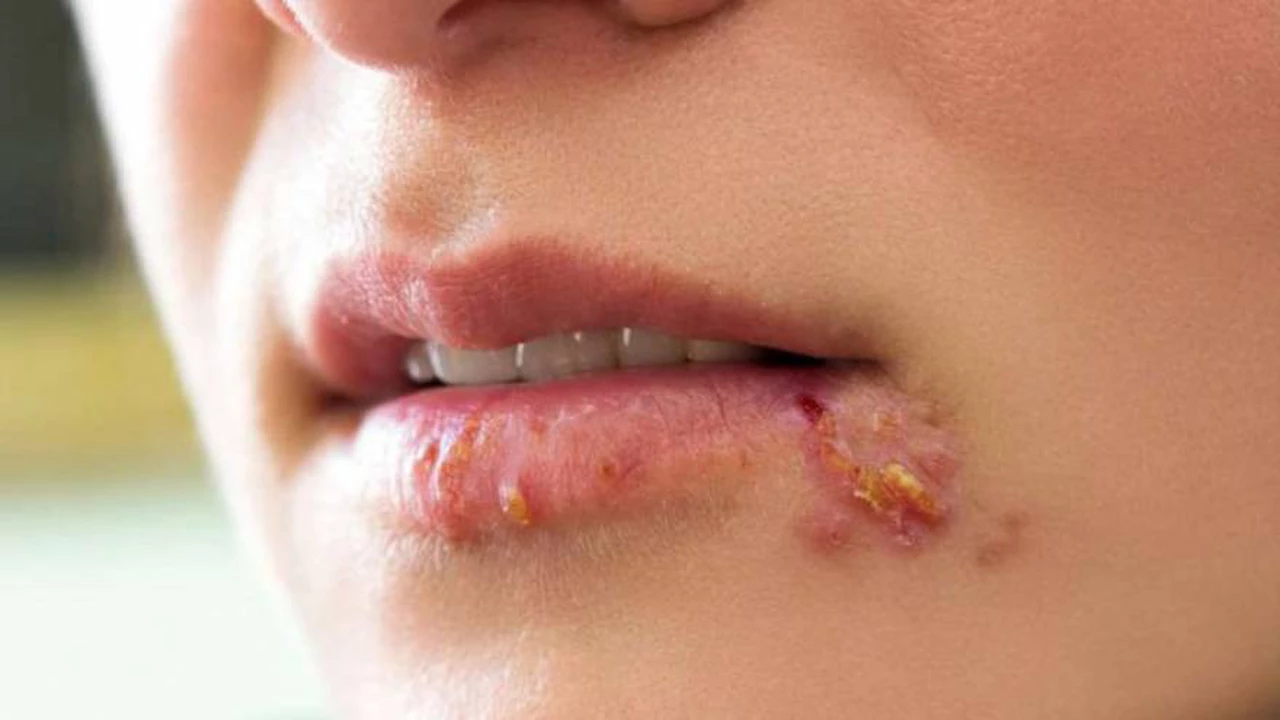Herpes labial: por qué sale y cómo curarlo rápido