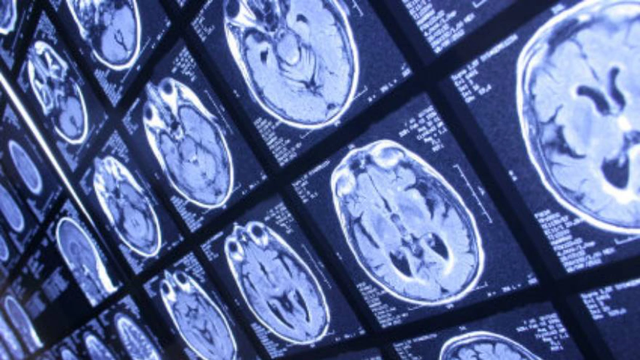 Un nuevo hallazgo podría ayudar a entender el origen del Alzheimer