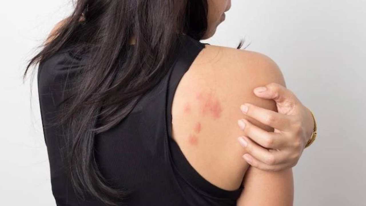 Cuáles son las consecuencias más graves de la dermatitis atópica: esto reveló una encuesta