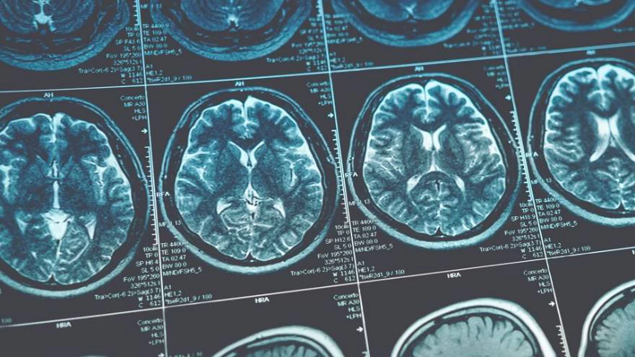 Crean un algoritmo que detecta los cambios cerebrales previos al Alzhéimer