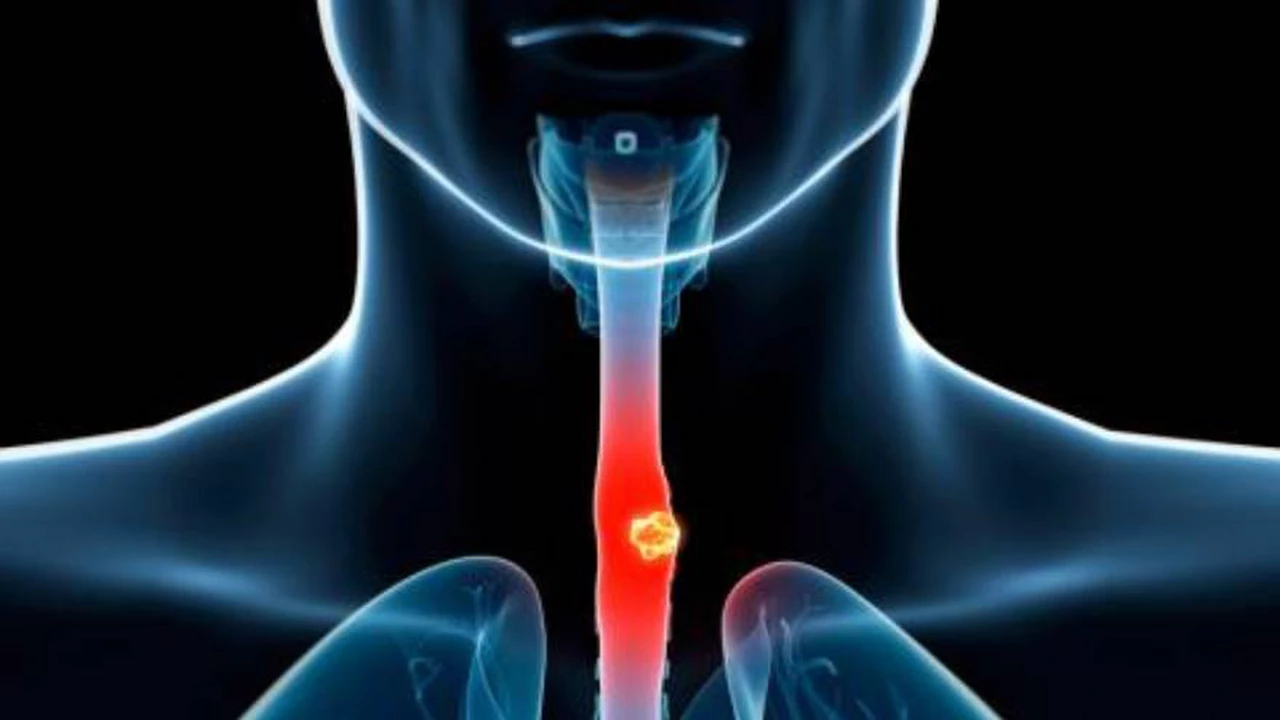 Cuáles son los síntomas del cáncer de esófago: señales de alerta claves para prestar atención