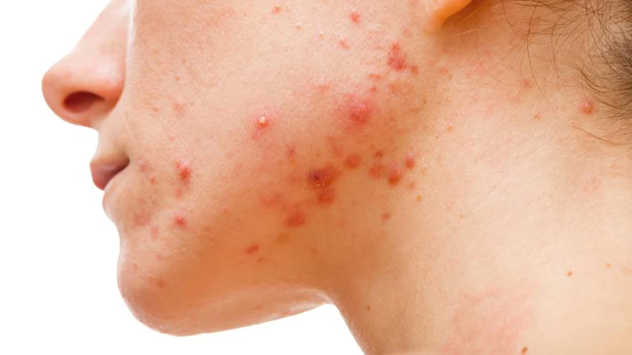 Acné y cuidado de la piel: 5 errores muy comunes que pueden afectar el tratamiento