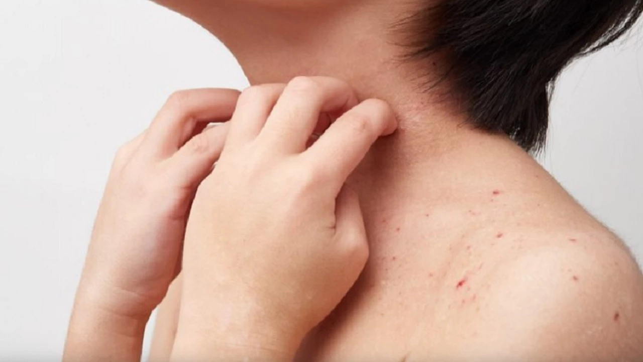 Cuánto impactan y cómo se pueden tratar los casos de dermatitis atópica moderada y severa