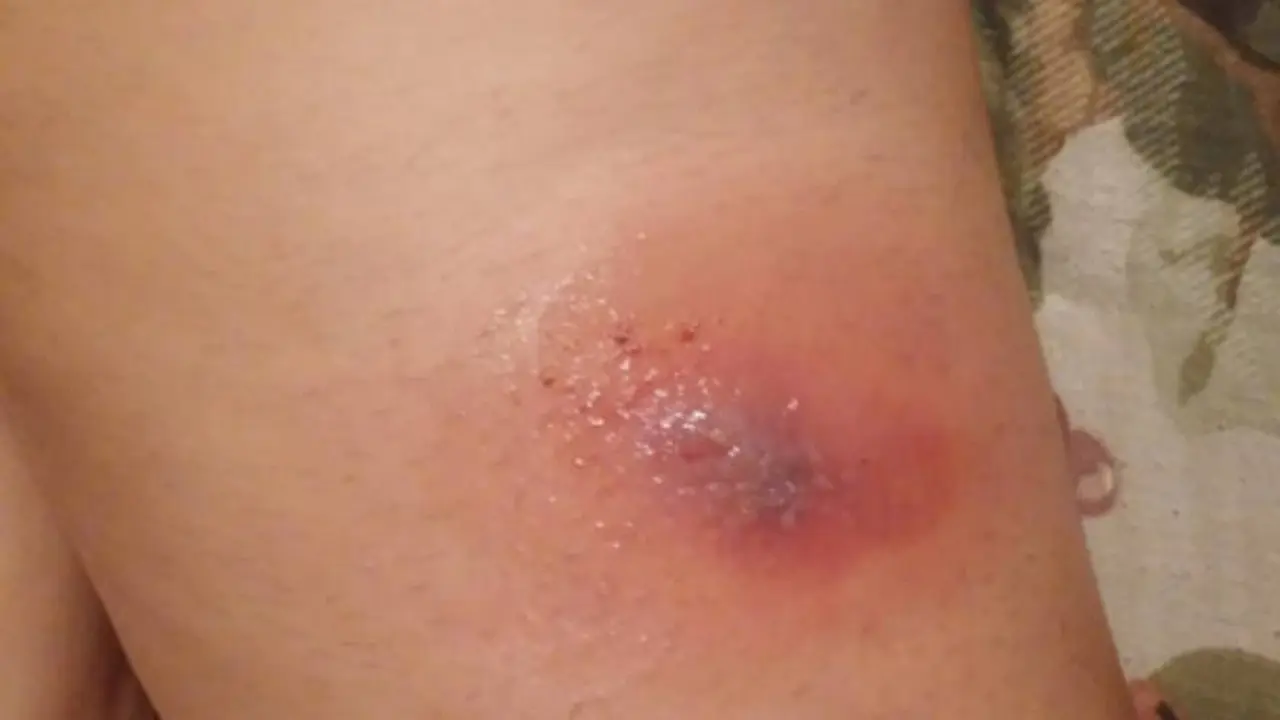 Esta es la picadura de la araña de rincón