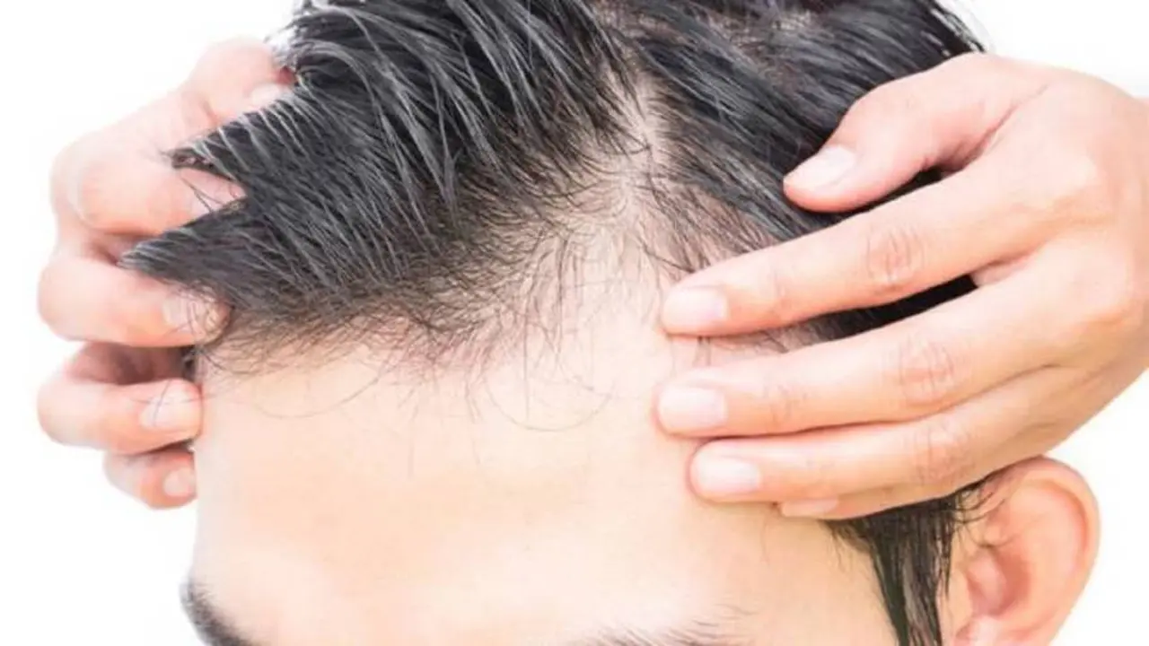 La caída del cabello puede afectar a hombres y a mujeres
