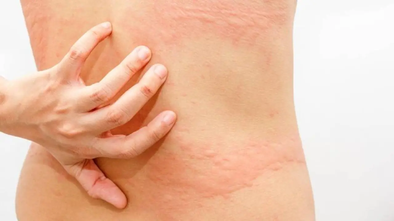 La urticaria es una de las causas de manchas rojas en la pielq