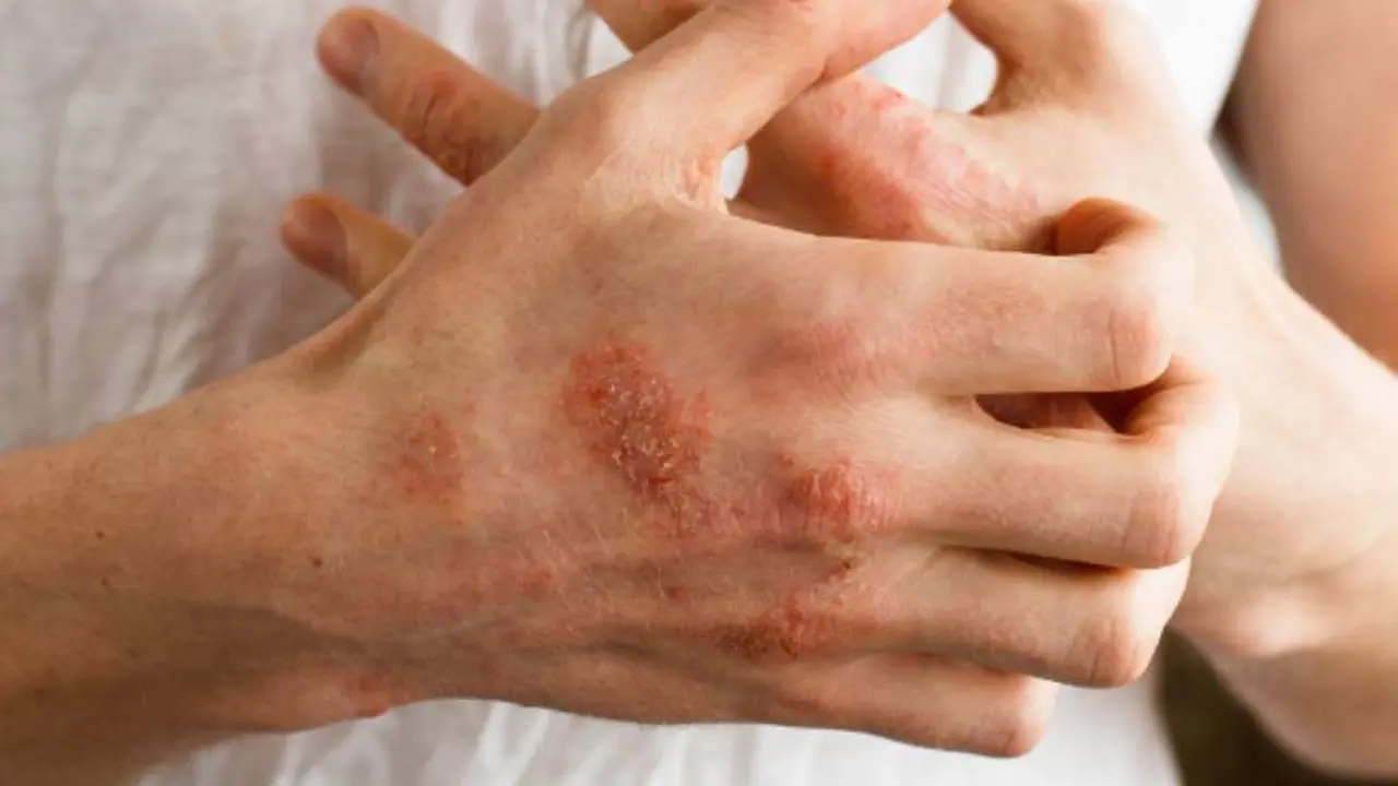 La dermatitis de contacto es una de las causas de manchas rojas en la piel