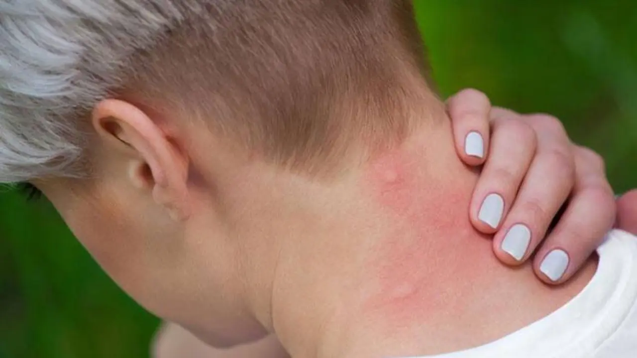 Así se ven las picaduras de mosquito y las manchas rojas que dejan en la piel