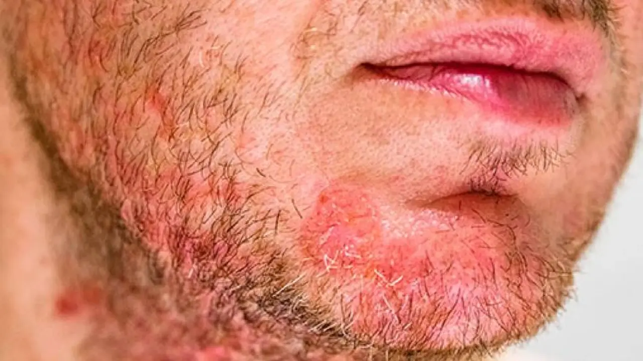 La dermatitis seborreica puede causar este tipo de manchas rojas en la piel