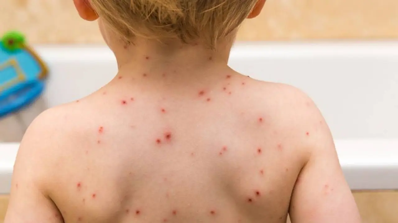 La varicela es una de las causas de manchas rojas en la piel