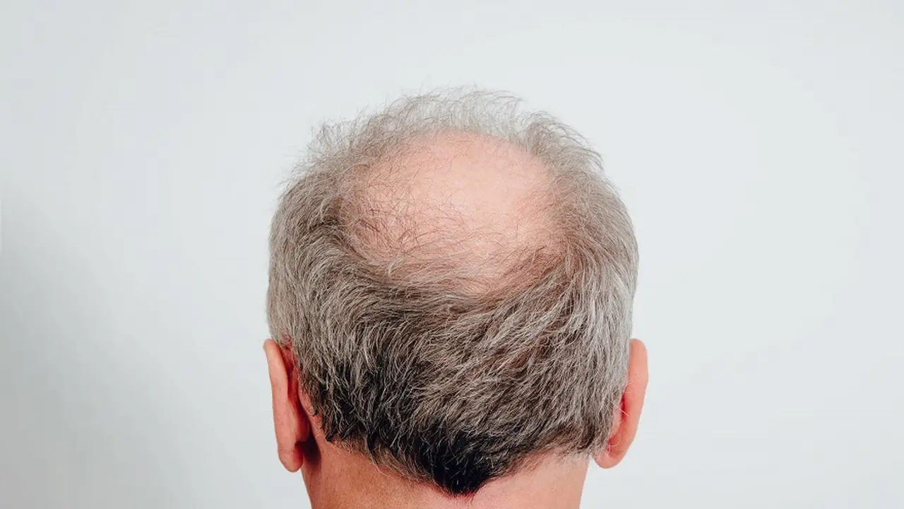 La causa de la pérdida de cabello podría 