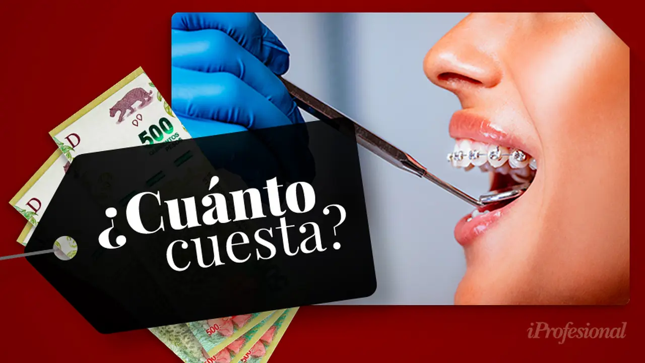Cuánto cuesta ponerse brackets en Argentina 2021: todo lo que tenés que saber sobre los aparatos fijos