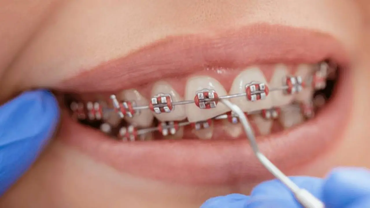 Cuánto cuesta ponerse brackets en Argentina 2021: la ortodoncia fija es distinta de la movible
