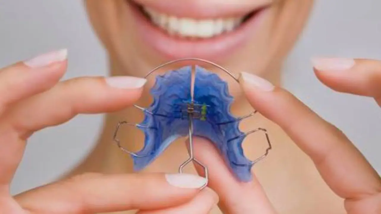Cuánto cuesta ponerse brackets en Argentina 2021: además de ortodoncia fija también es posible usar ortodoncia movible