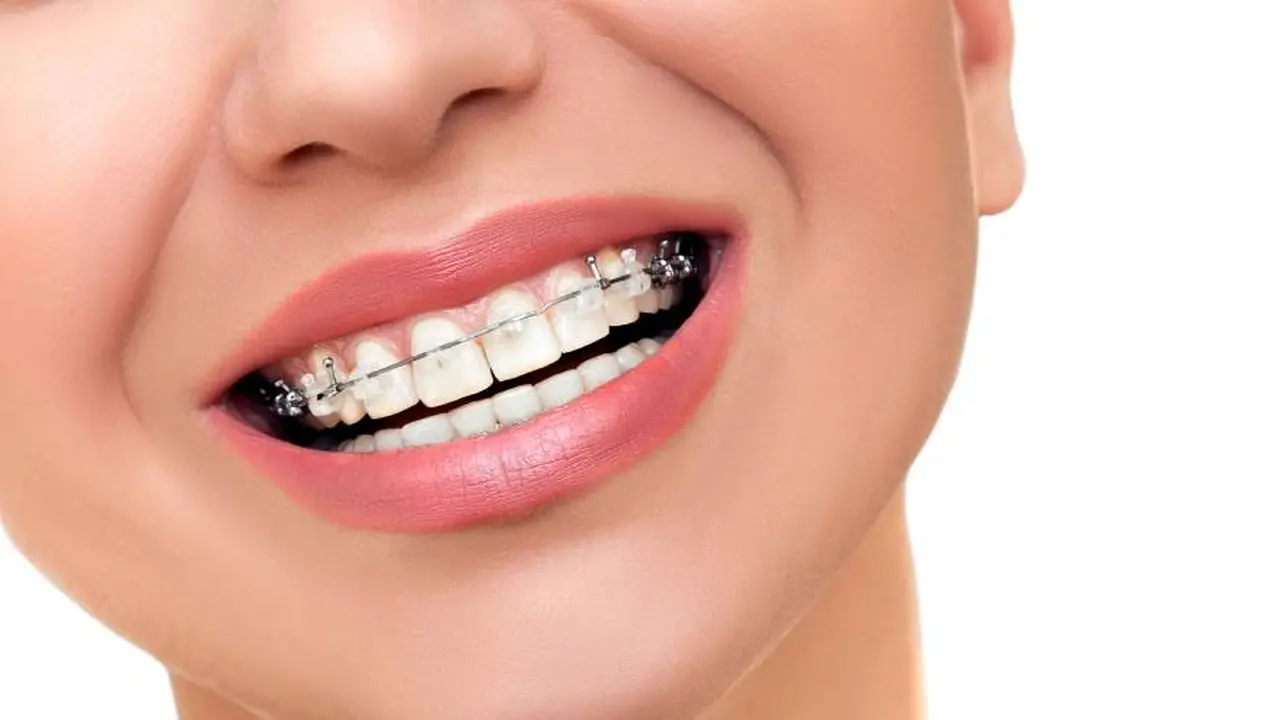 Cuánto cuesta ponerse brackets en Argentina 2021: además de ortodoncia fija también es posible usar ortodoncia movible