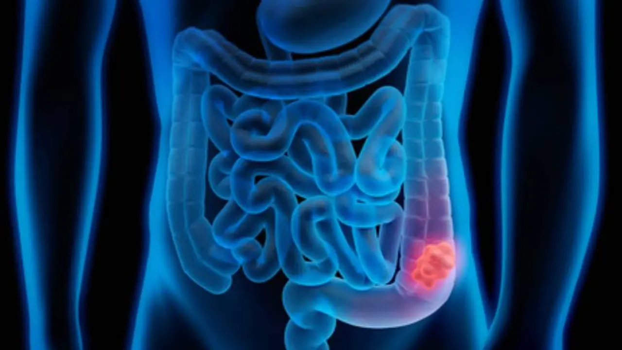 Expertos han detectado una mayor cantidad de casos de cáncer colorrectal a una edad más temprana