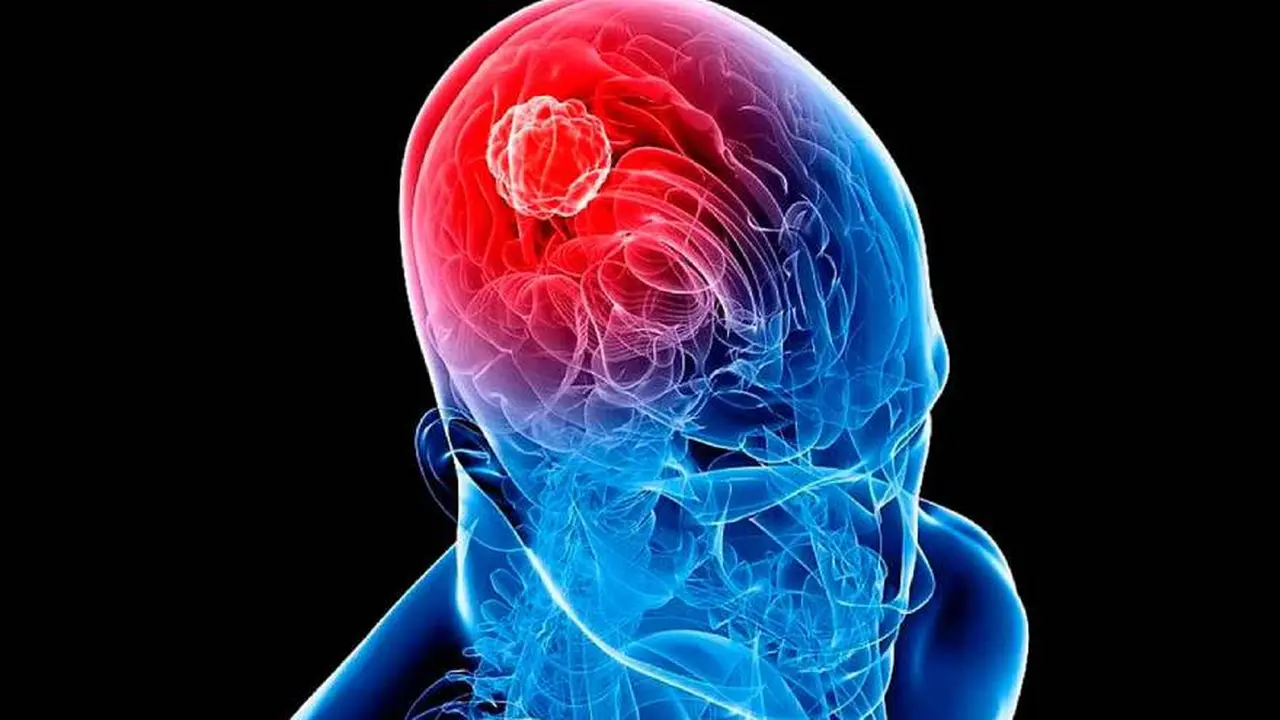 Cómo es el tratamiento que logró eliminar por completo tumores cerebrales en pacientes terminales