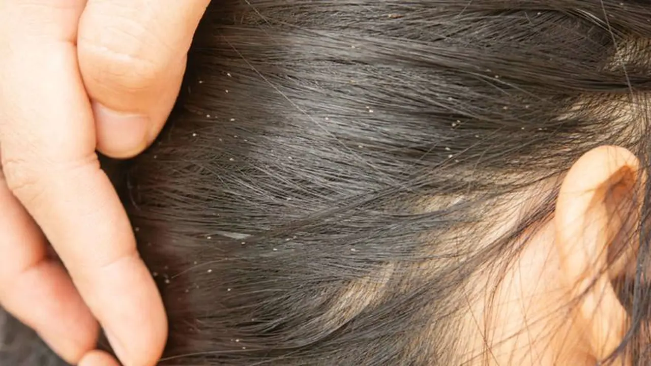 Qué significa soñar con piojos: significado de los sueños