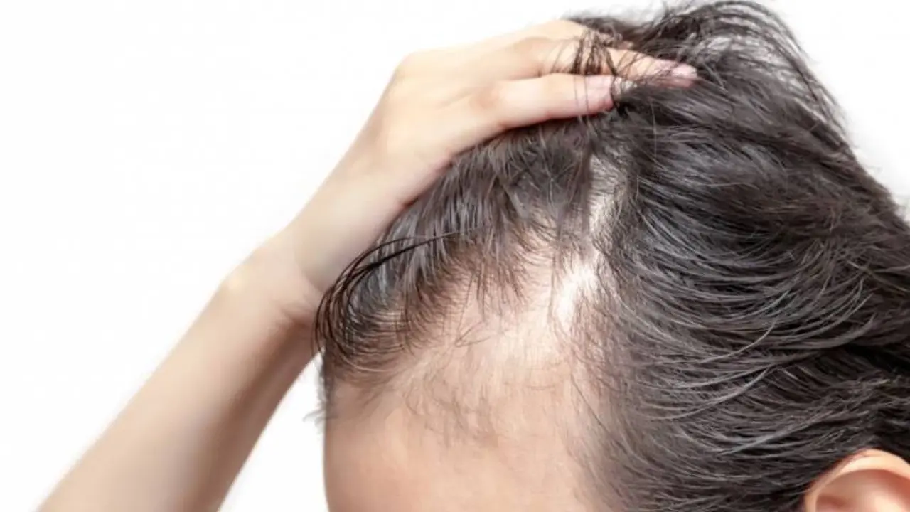 Los genes responsables por la alopecia pueden venir de cualquier lado de la familia