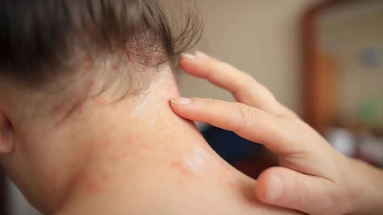 La  dermatitis herpetiforme