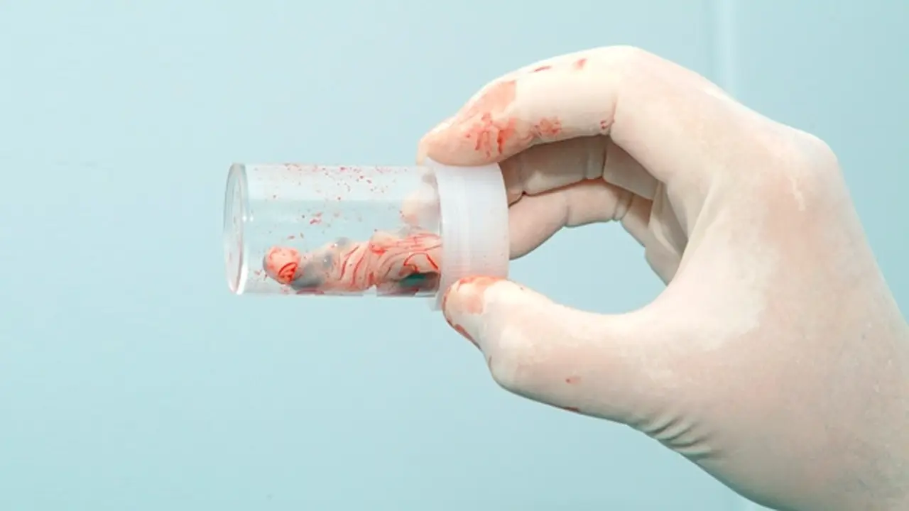 Recolectar la sangre y tejido del cordón umbilical al momento del parto es una práctica importante para el futuro de la persona recién nacida