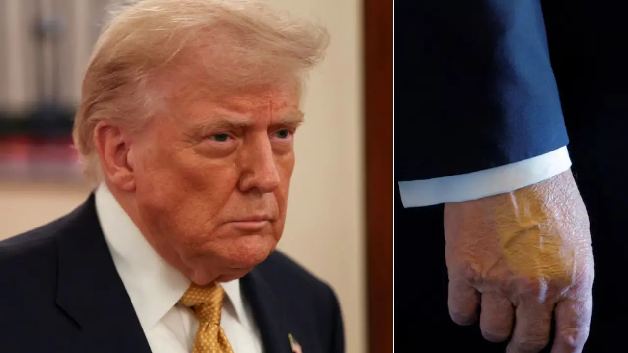 La Casa Blanca reveló que Trump sufre una "insuficiencia venosa crónica": qué síntomas padece