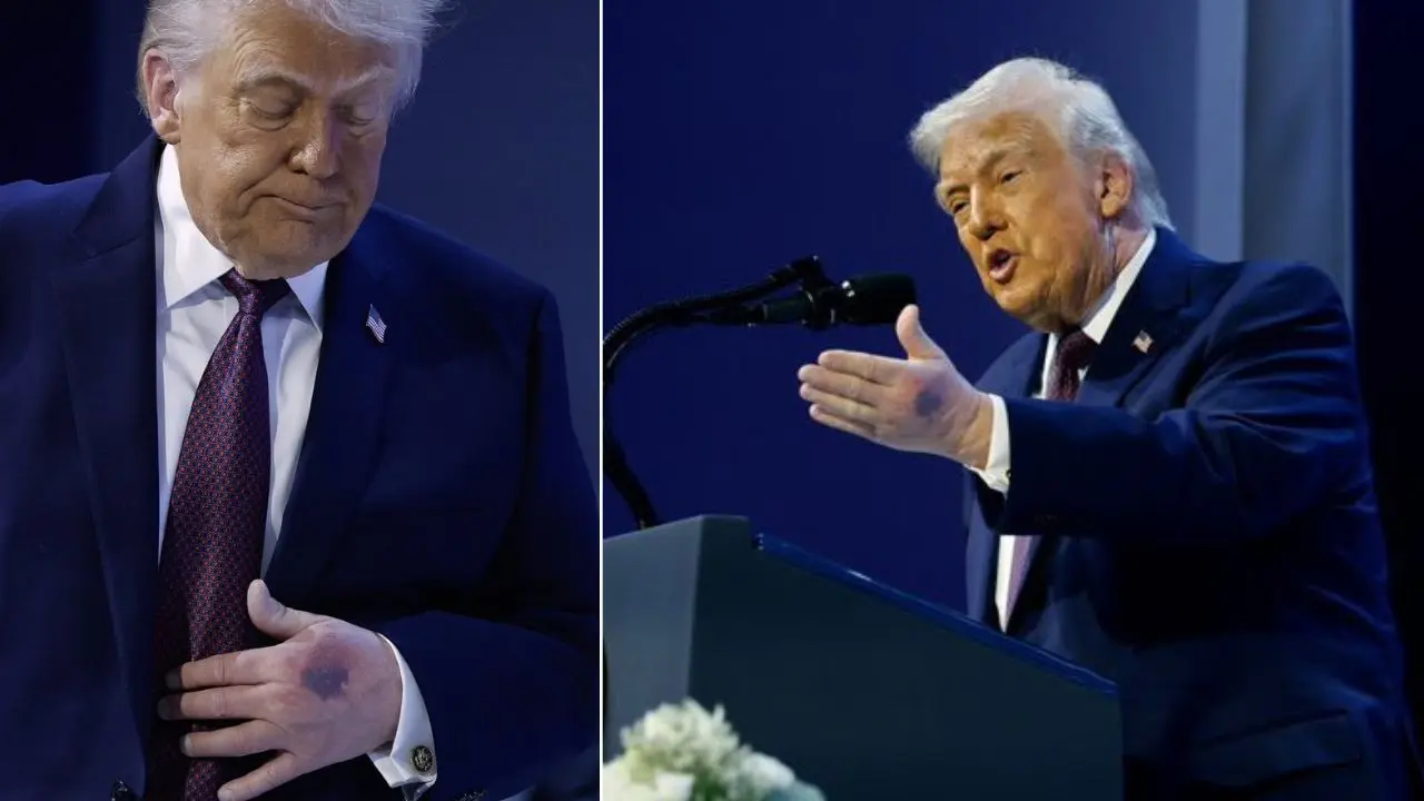 El moretón en la mano de Trump generó preocupación por su salud en Davos