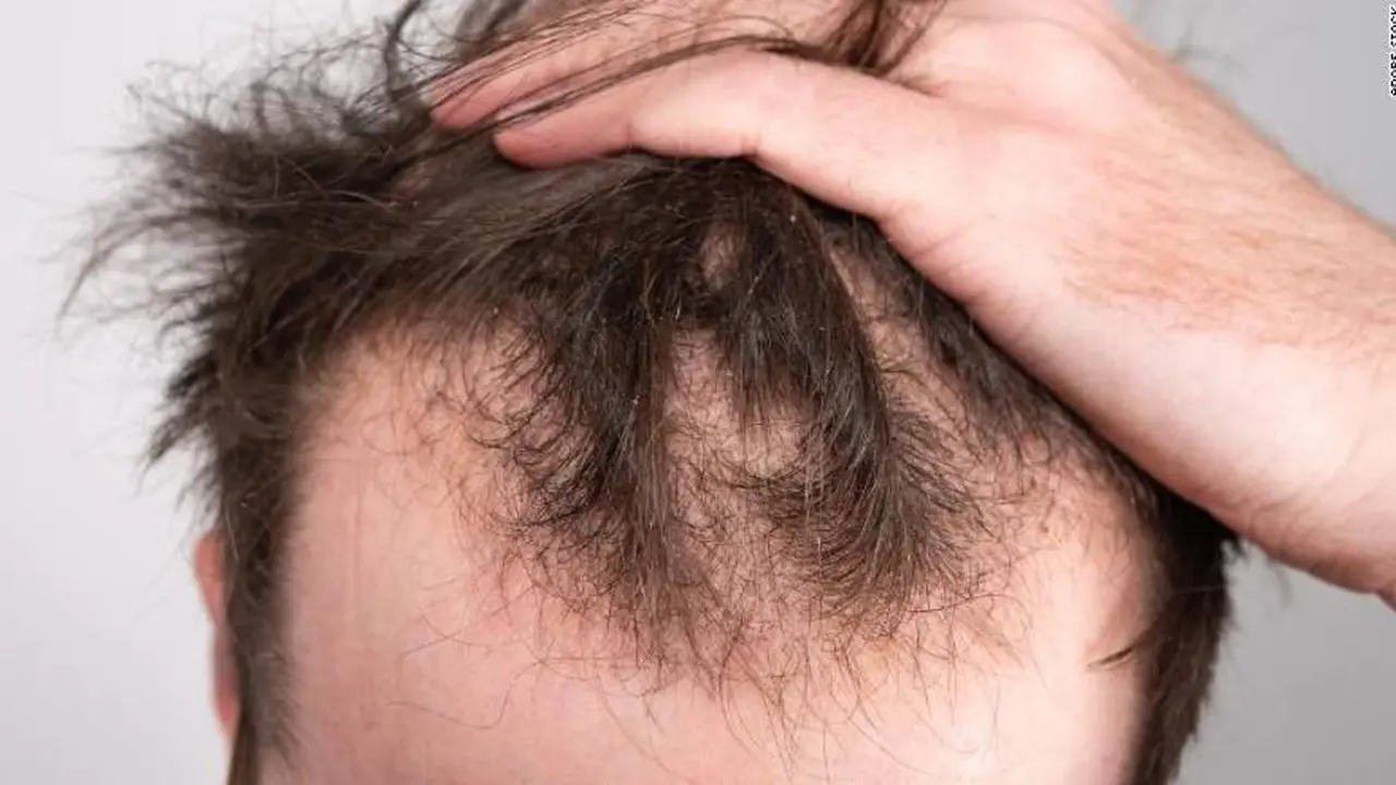 usar gorras o lavarse mucho el cabello hace que se caiga