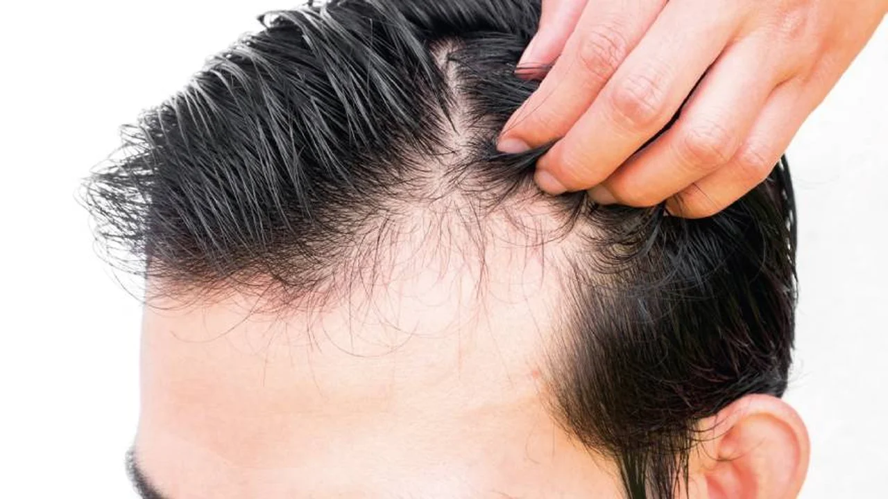 Cómo saber si te vas a quedar calvo y a qué edad empezarás a perder pelo