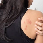 Cuáles son las seis causas más frecuentes de aparición de manchas rojas en la piel