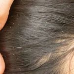 Qué significa soñar con piojos: significado de los sueños