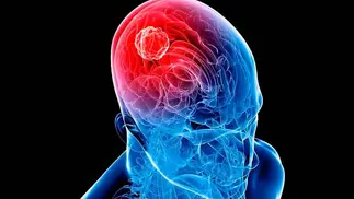 Nuevo medicamento para tumor cerebral llega a Argentina después de 20 años de espera