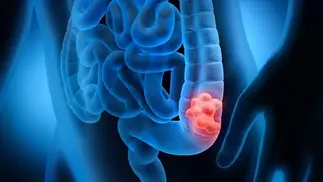 Cáncer colorrectal crece sin freno y nuevos tratamientos ofrecen esperanza real