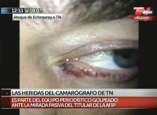 Ataque a periodistas: así­ quedó el camarógrafo tras la golpiza de la 'patota de Echegaray'