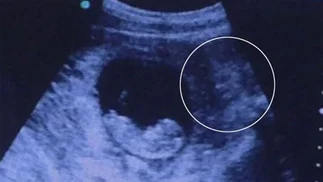 Polémica por la ecografí­a que mostró a 'un demonio vigilando al feto'