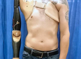 Desarrollan un brazo protésico que detecta señales de la médula espinal