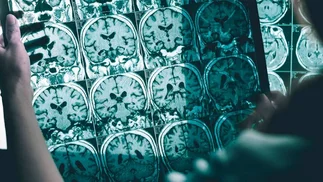Alzheimer: síntomas y avances en tratamientos de esta enfermedad