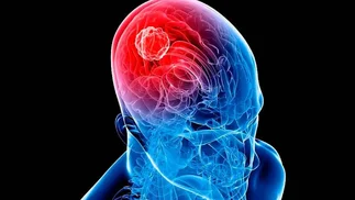 Nuevo medicamento para tumor cerebral llega a Argentina después de 20 años de espera