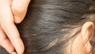 Qué significa soñar con piojos: significado de los sueños