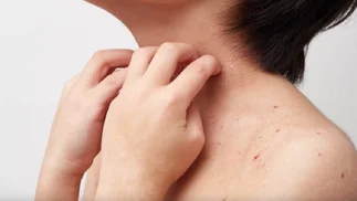 Dermatitis atópica: cuánto impacta y cómo se puede tratar