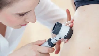 Cáncer de piel: el ABC para realizarse un correcto autoexamen