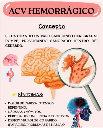 Los síntomas de un ACV hemorrágico, según