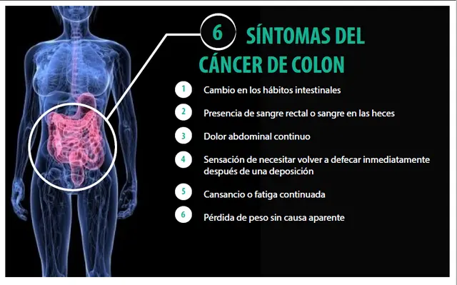 Infografía sobre síntomas del cáncer de colon