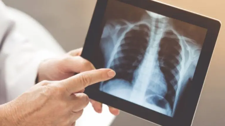 Experta advierte que los pulmones de un paciente con Covid-19 se ven peor que los de un fumador