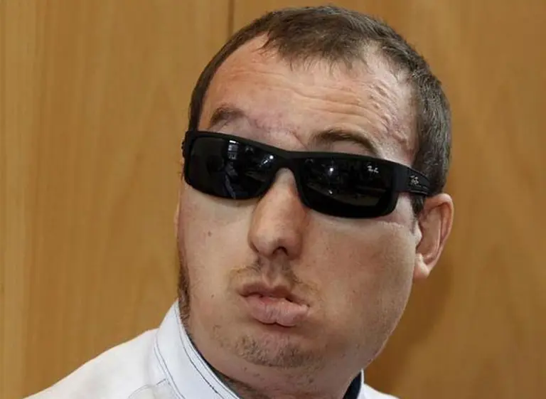 Dan de alta al primer paciente polaco con trasplante de cara