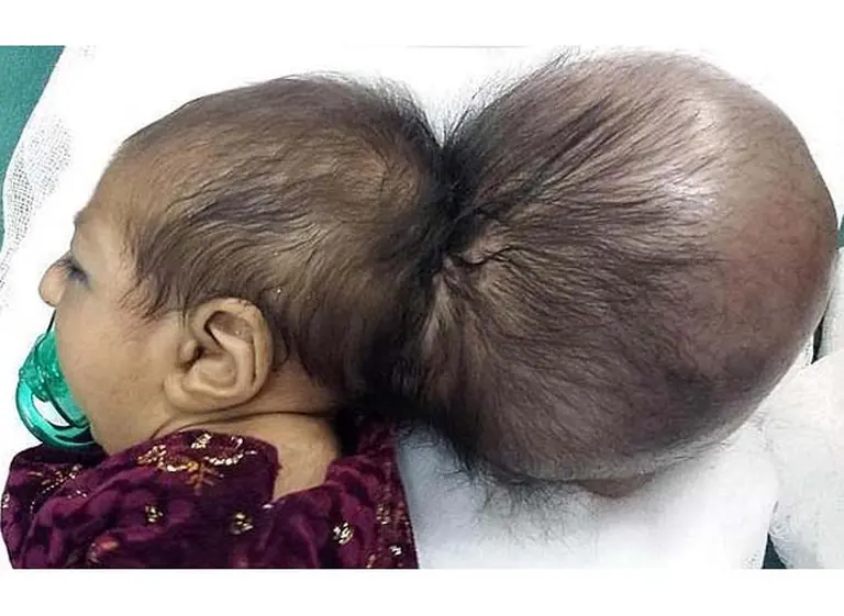 Operan con éxito a una bebé afgana que nació con una segunda cabeza